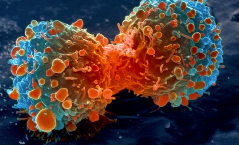Descubren una proteína que mantiene ‘dormida’ la metástasis del cáncer de mama