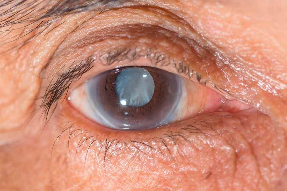 Retransmisión: Conferencia Glaucoma, el cegador silencioso