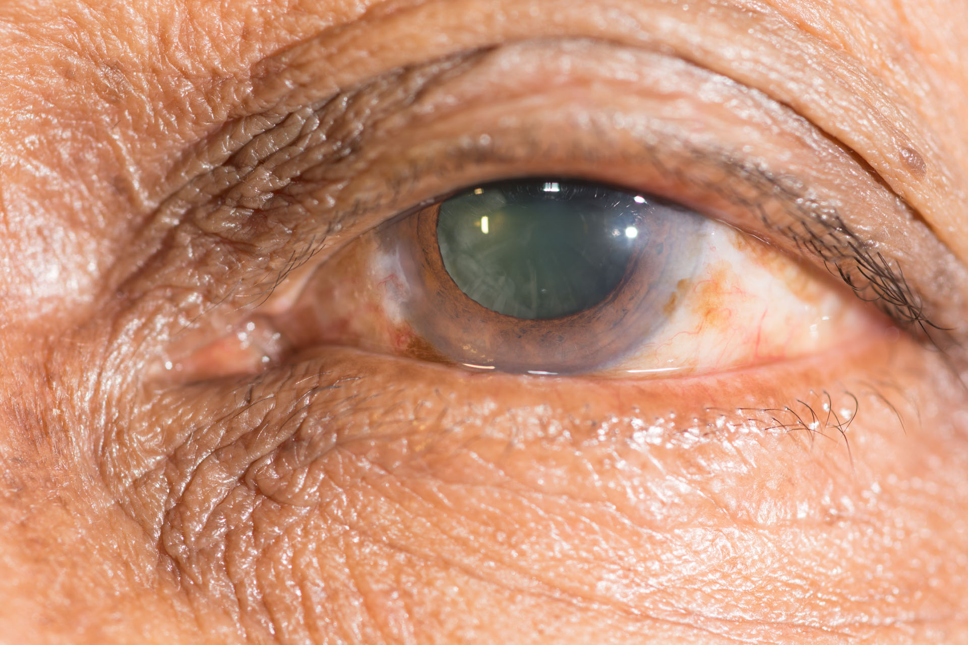 Cataratas, causa más común de pérdida de la visión en personas mayores