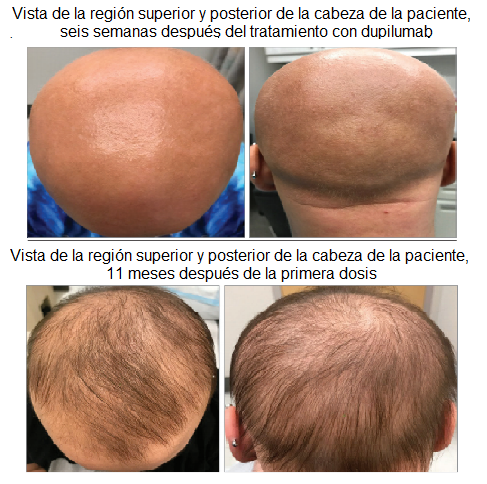 Medicamento para el eccema ser útil para tratar alopecia. | UNAM Global