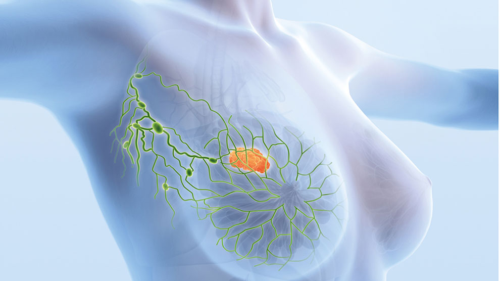 Factores de riesgo para desarrollar cáncer de mama, ¿los conoces?