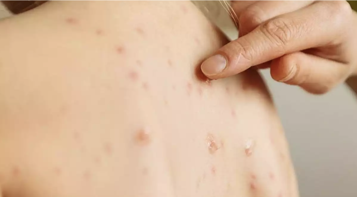Brotes de sarampión en aumento a causa de los antivacunas