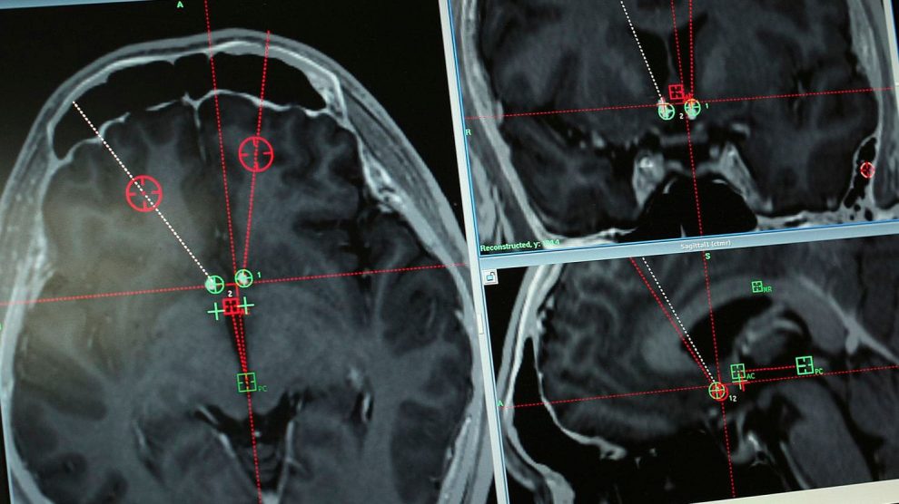 DBS-prueban-implantes-cerebrales-UNAMGlobal