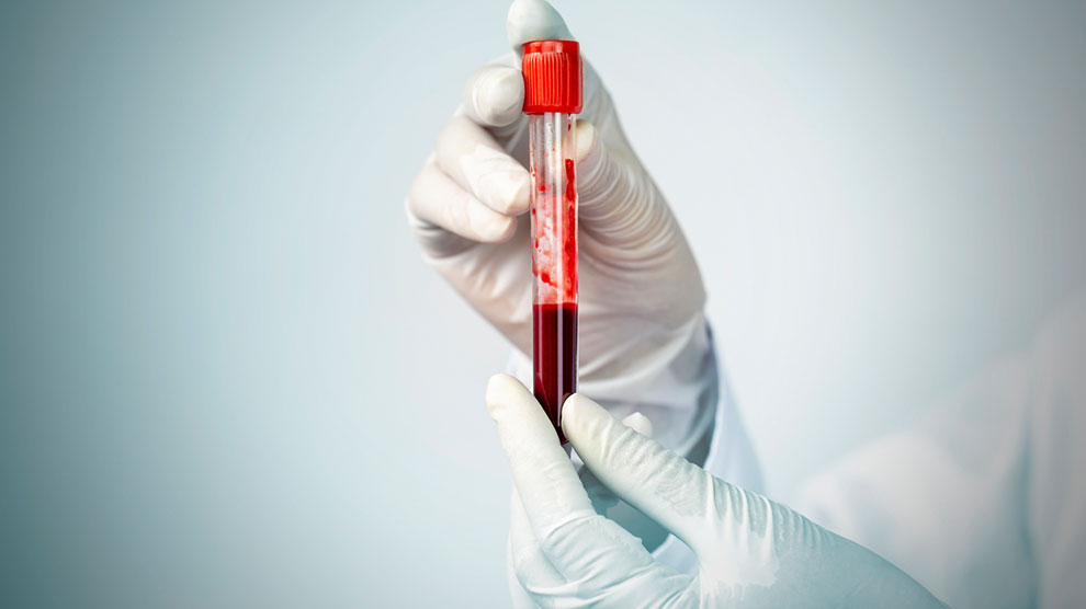 mínima-muestra-sangre-detecta-daño-renal-UNAMGlobal