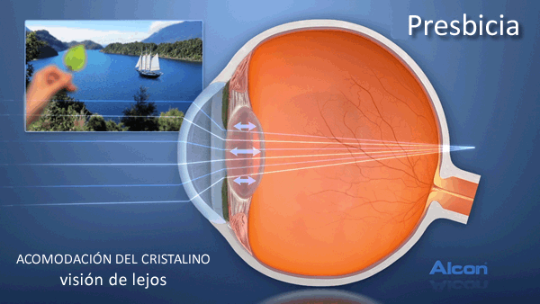 Investigadores desarrollan un lente intraocular capaz de imitar al cristalino