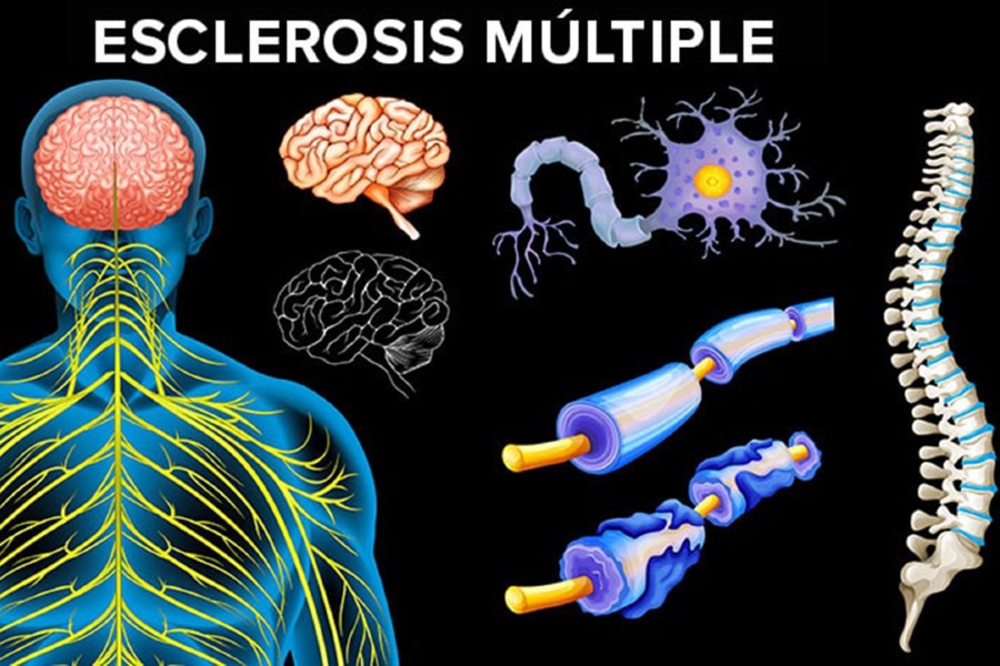 Esclerosis múltiple, primera causa de discapacidad de origen neurológico