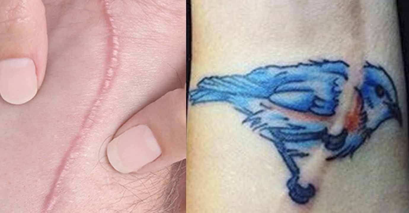 ¿Se puede tatuar una cicatriz?
