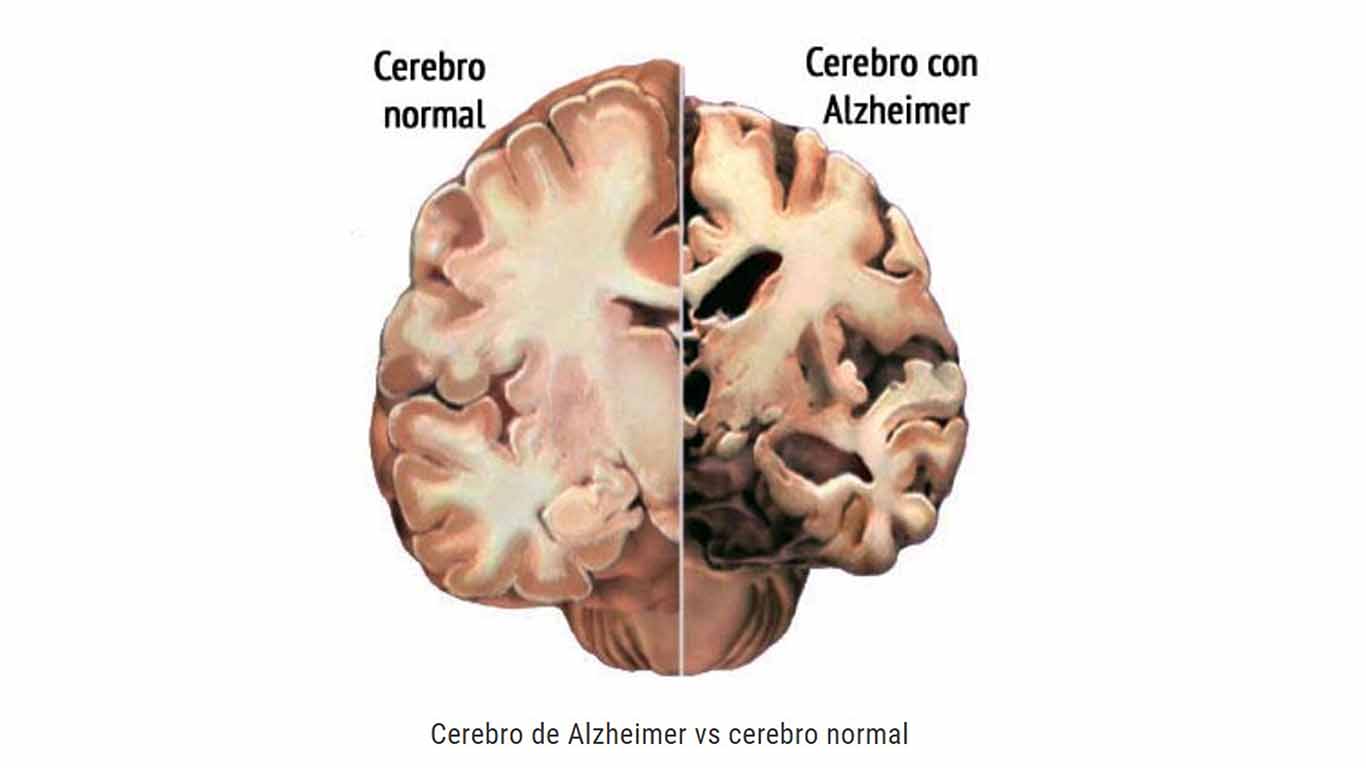 Alto consumo de grasas podría asociarse con alzhéimer
