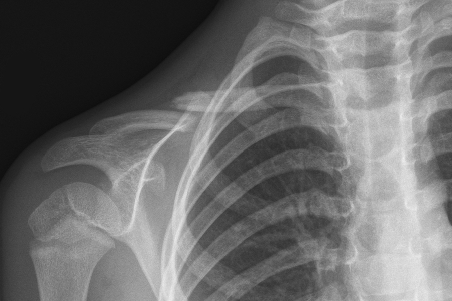 ¿Cuáles son las fracturas de huesos más comunes según la edad?