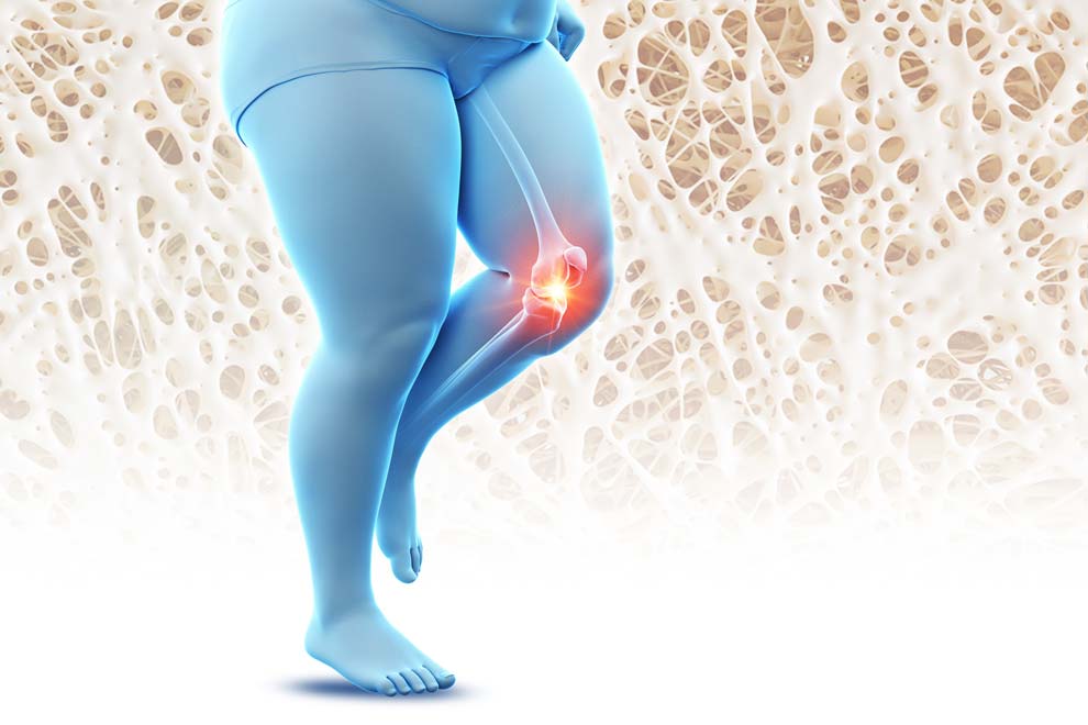 Obesidad y osteoporosis, relación positiva