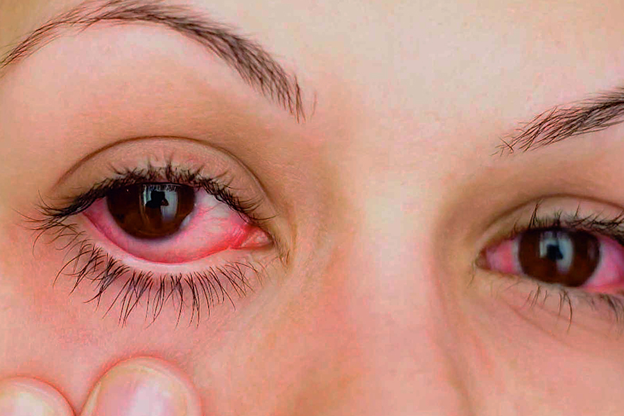 Ojos rojos, un riesgo a cuenta gotas