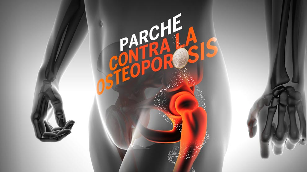Crean parche para tratar osteoporosis