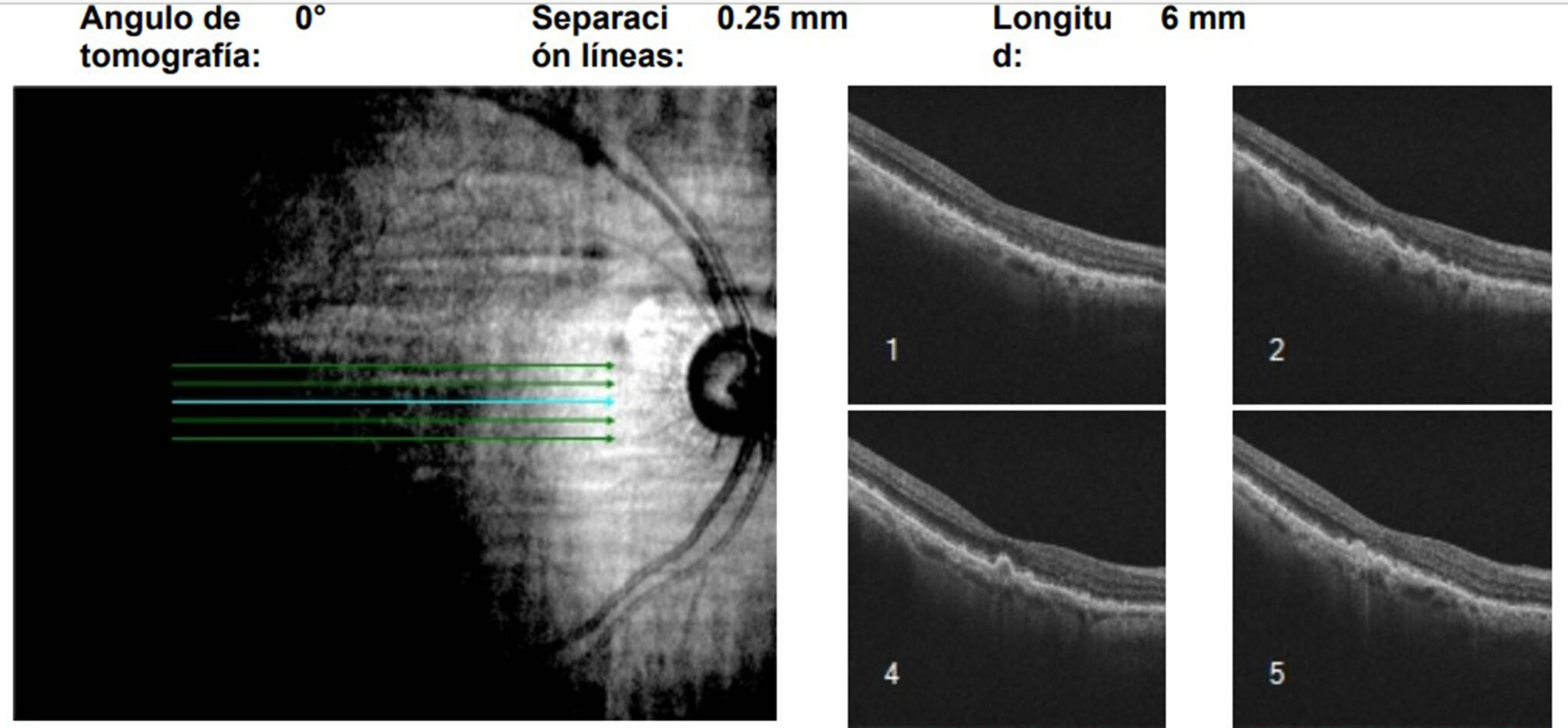 Glaucoma La Principal Causa De Ceguera Irreversible Unam Global 5616