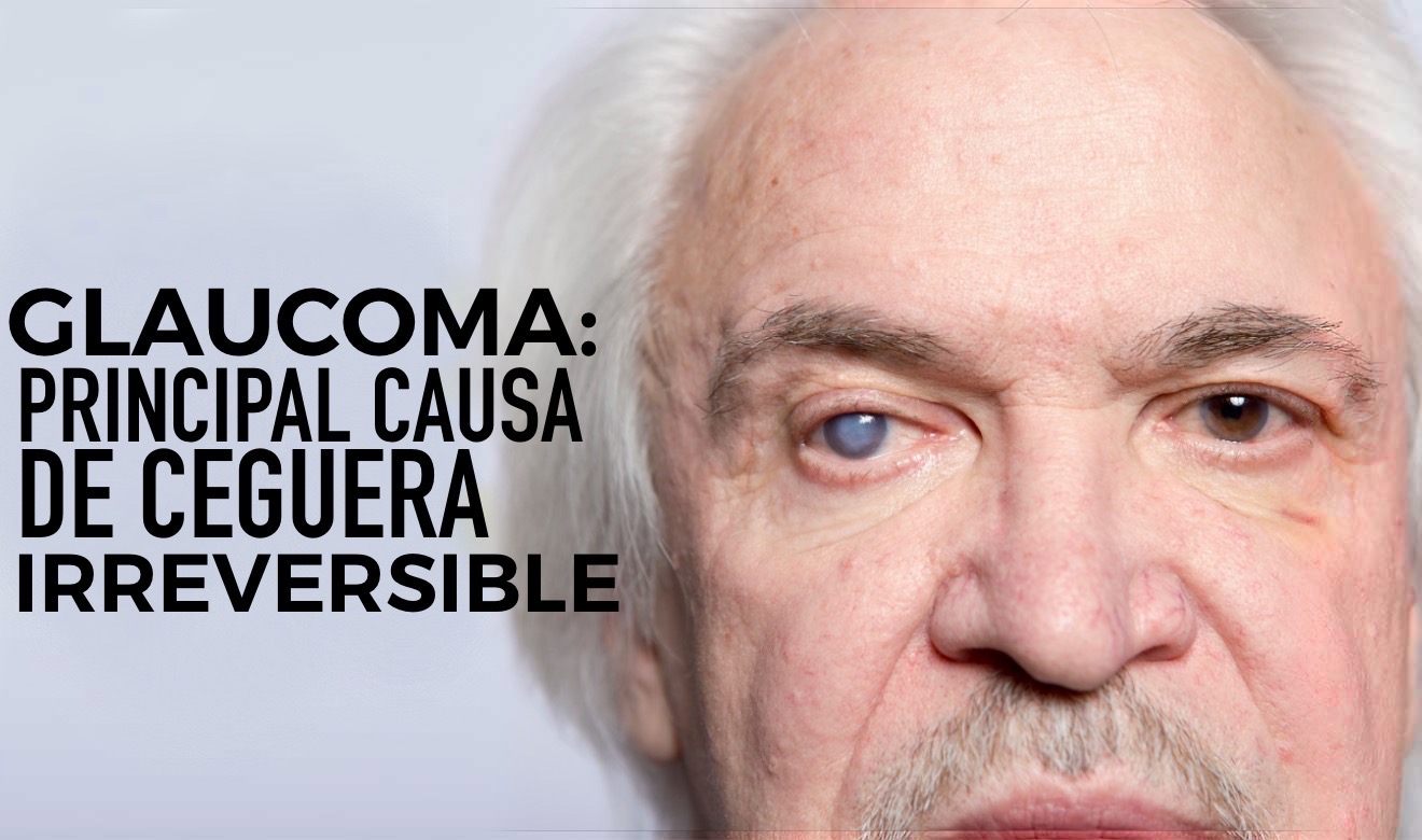 Glaucoma, la principal causa de ceguera irreversible